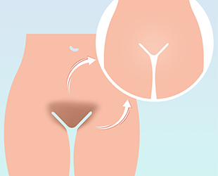 genital-beyazlatma-768x768